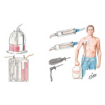 Chest Draining Methods: Underwater-Seal Drainage of Chest; Heimlich Valve