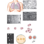 Systemic Lupus Erythematosus (SLE); Lung Involvement