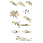 Implant Resection Arthroplasty for Metacarpophalangeal Joints