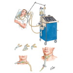 Mechanical Ventilation