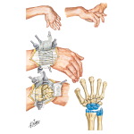 Implant Resection Arthroplasty for Radiocarpal Joint