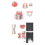Laryngeal Granuloma and Tracheal Stenosis