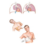 Open (Sucking) Pneumothorax