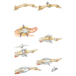 Procedures for Metacarpophalangeal Disabilities of Thumb
