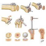 Technique for Total Knee Replacement