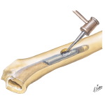 Fractures of Femur and Femoral Component