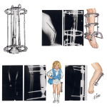 Ilizarov and De Bastiani Techniques for Limb Lengthening