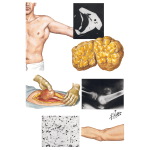 Lipoma, Neurofibroma, Myositis Ossificans