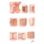 Plastic Tracheal Reconstruction