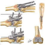 Technique for Total Knee Replacement