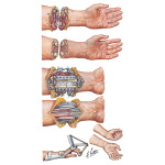 Replantation of Forearm