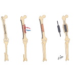 Limb-Salvage Procedures for Reconstruction of Diaphysis After Resection for Tumor