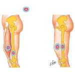 Surgical Margins for Musculoskeletal Tumors