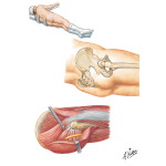 Technique for Total Hip Replacement