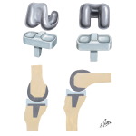 Total Condylar Knee Prosthesis