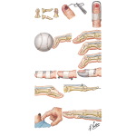 Injury to Fingers