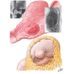 Benign Tumors of Stomach