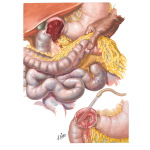 Peptic Ulcer VIII - Complications of Gastric and Duodenal Ulcers