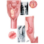 Benign Tumors