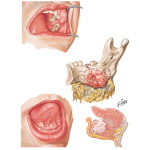 Malignant Tumors III - Jaws