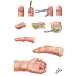 Surgical Incisions