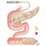 Biochemical Changes in Pancreatic Obstruction