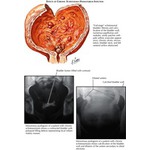 Heimlich Maneuver Techniques: Adult Victim Supine