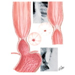 Stricture