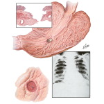 Peptic Ulcer VIII - Complications of Gastric and Duodenal Ulcers