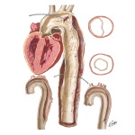 Aneurysms of the Aorta