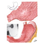 Carcinoma of Stomach