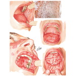 Oral Manifestations in Various Skin Conditions