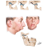 Abnormalities of Temporomandibular Joint