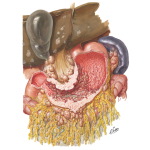 Spread of Carcinoma of Stomach