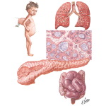 Congenital Cystic Disease