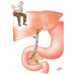Postcholecystectomy Syndrome