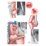 Diverticula