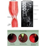 McBride Operation for Bunion; Mitchell Osteotomy / Bunionectomy