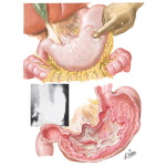 Peptic Ulcer V - Giant Ulcer