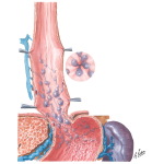 Varicosis