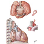 Rheumatic Heart Disease V - Mitral Stenosis:  Secondary Anatomic Effect