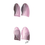 Patterns of Lobar Collapse; Left Lung (after Lubert and Krause)