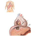 Amebic Pericarditis