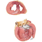 Arteriosclerotic Heart Disease