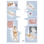 Glycogen Storage Diseases