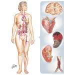 Rheumatic Heart Disease VIII - Mitral Stenosis: Thromboembolic Complications