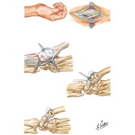 Trapezium Implant Resection Arthroplasty for Thumb Disabilities