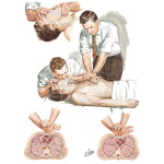 Cardiopulmonary Arrest and Treatment - External Resuscitation