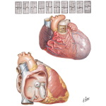 Anomalous Left Coronary Artery and Aneurysm of the Sinus of Valsalva