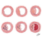 Atherosclerosis